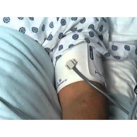 Welch Allyn Flexiport Thigh Cuff size 13 One Tube Bayonet (40-55cm)